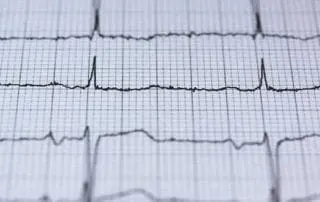 EKG Rhythms