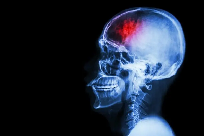stroke - x-ray of head