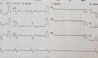 sick sinus syndrome - ecg reader