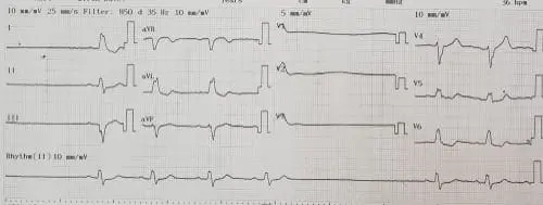 sick sinus syndrome - ecg reader