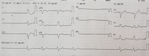 image-result-for-sick-sinus-syndrome-ecg-my-xxx-hot-girl